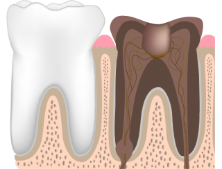 虫歯レベルC4