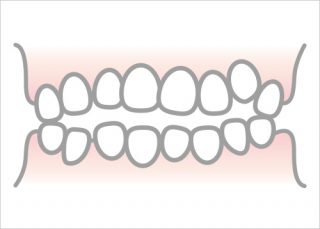 叢生（乱くい歯・八重歯）