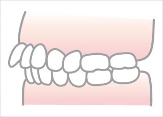 上顎前突（出っ歯）