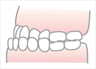下顎前突（受け口・反対咬合）