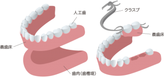 保険の義歯（入れ歯）
